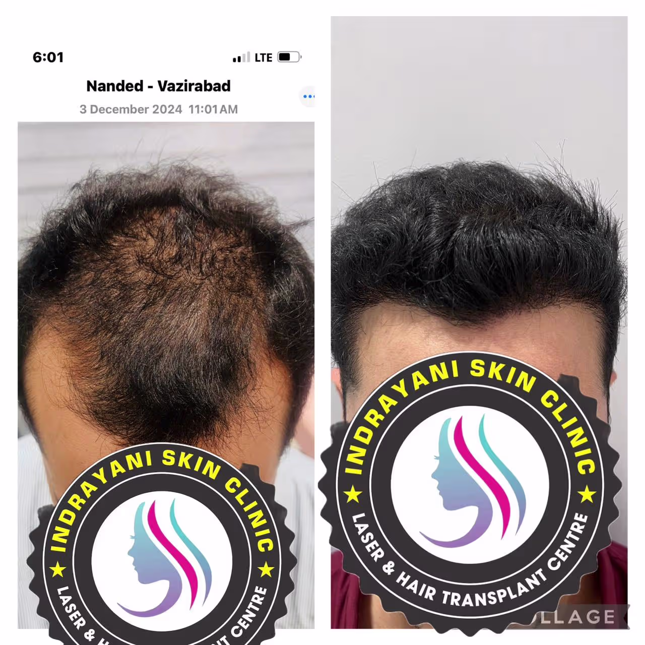 inrayani-skin-clinic-results